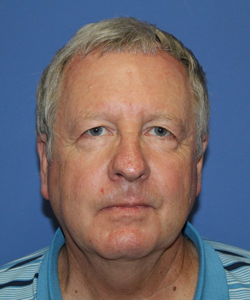Blepharoplasty before photo