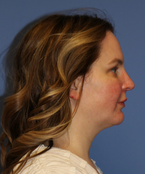 Liposuction before and after results
