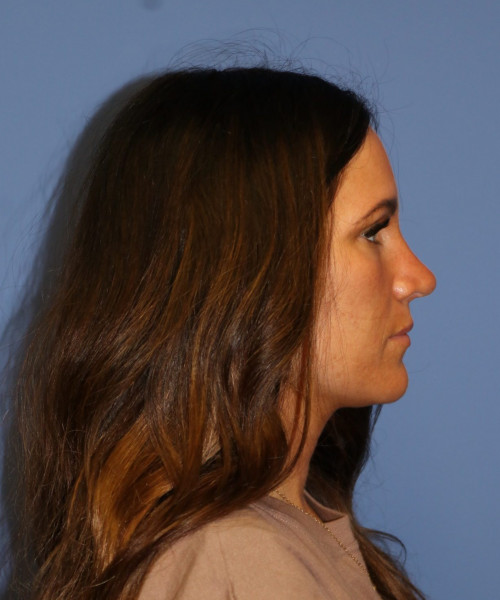 A result from Bitner Facial Plastic Surgery of Utah