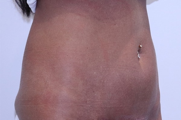 A result from Farber Plastic Surgery