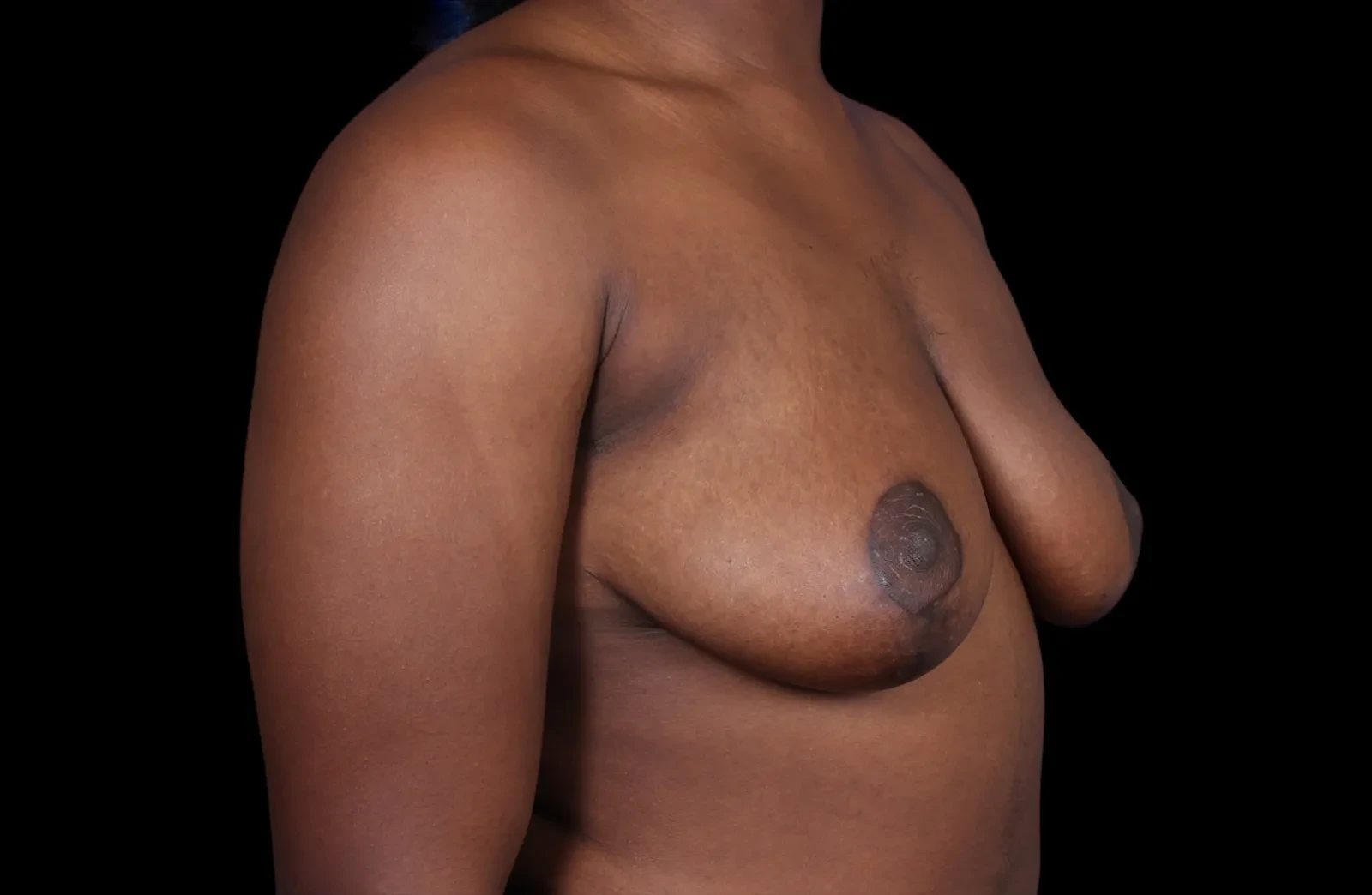 A result from Dr. Raja Mohan Plastic Surgery