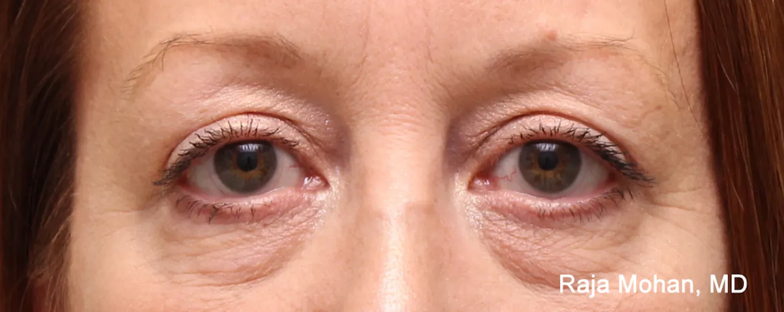 A result from Dr. Raja Mohan Plastic Surgery