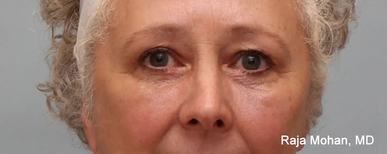 A result from Dr. Raja Mohan Plastic Surgery