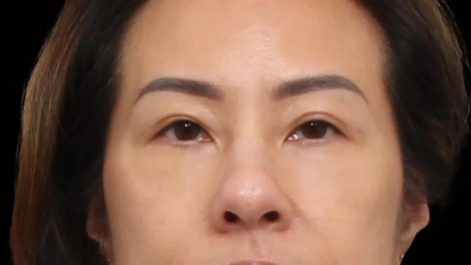A result from Dr. Raja Mohan Plastic Surgery