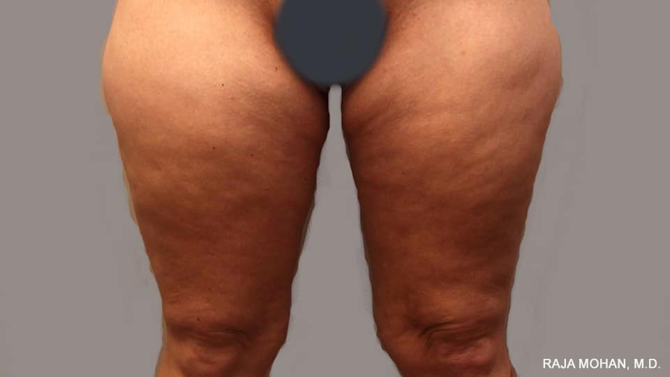 A result from Dr. Raja Mohan Plastic Surgery
