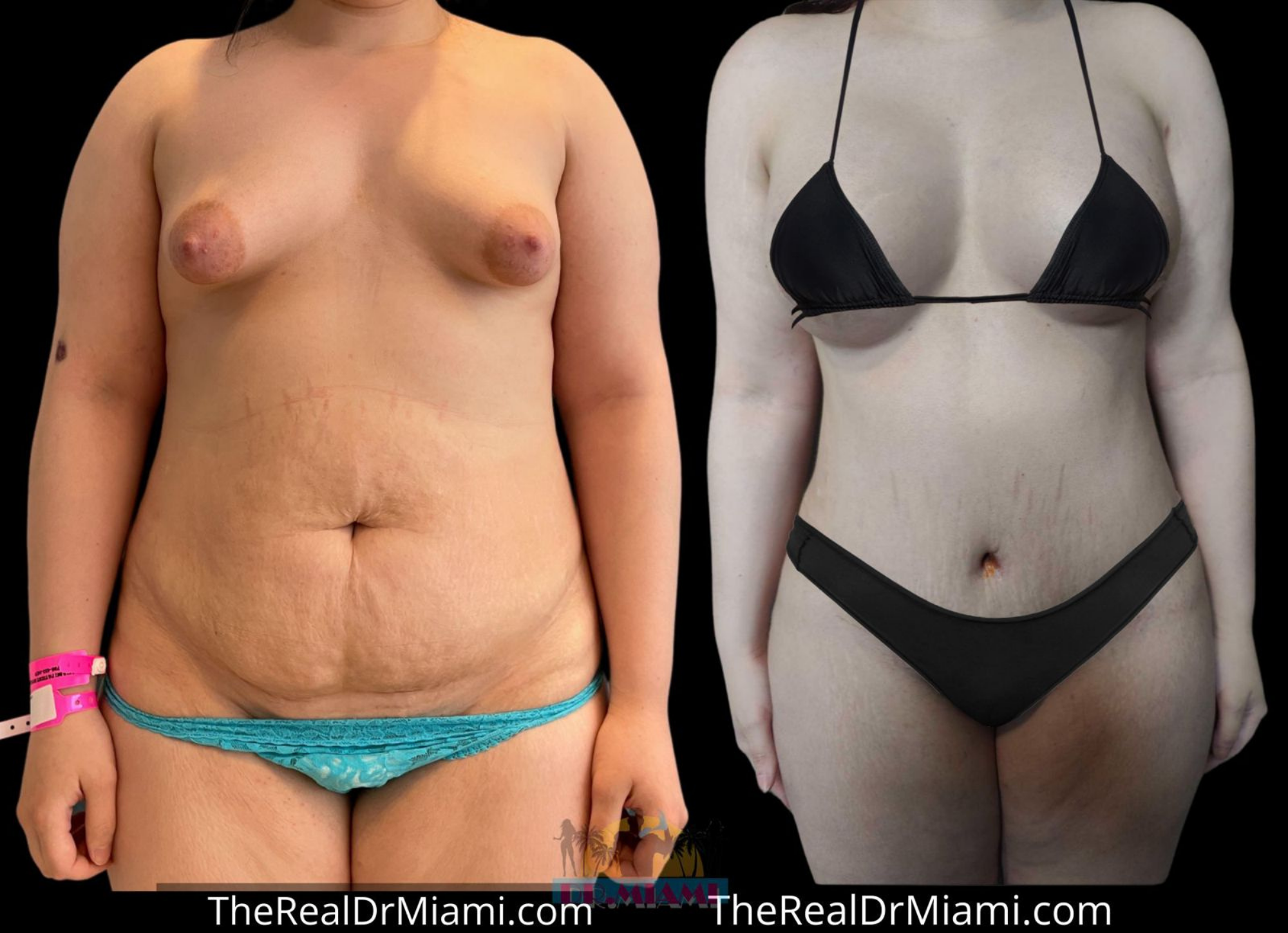 A result from Dr. Miami - Michael Salzhauer