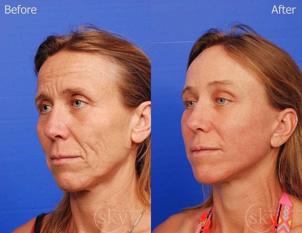 A result from SKY Facial Plastic Surgery