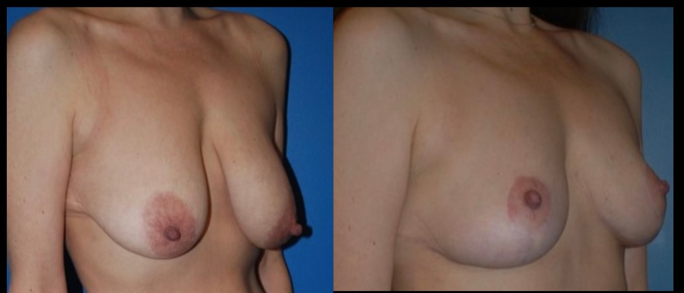 A result from Stanwix Plastic Surgery