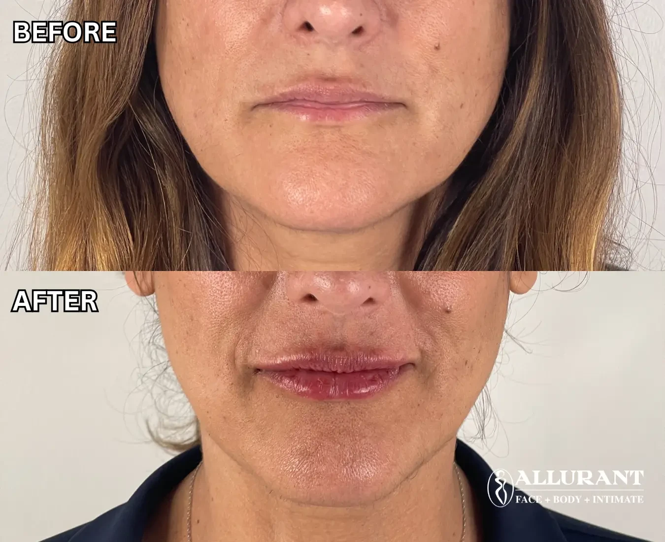 A result from Allurant Medical Spa