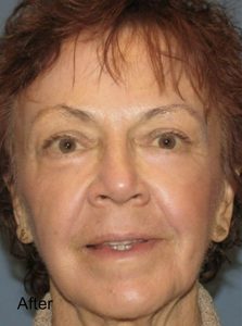 A result from Beverly Hills Aesthetics