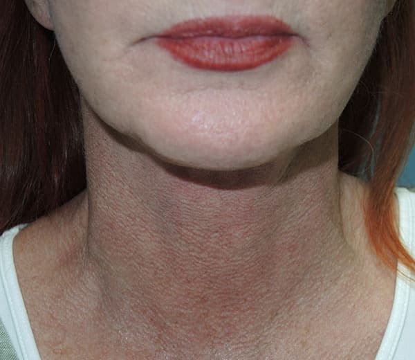 A result from Arkansas Oculoplastic Surgery, PLLC: Brock Wade D MD