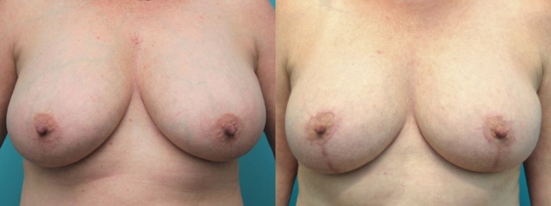 A result from Modern Surgical Arts of Denver