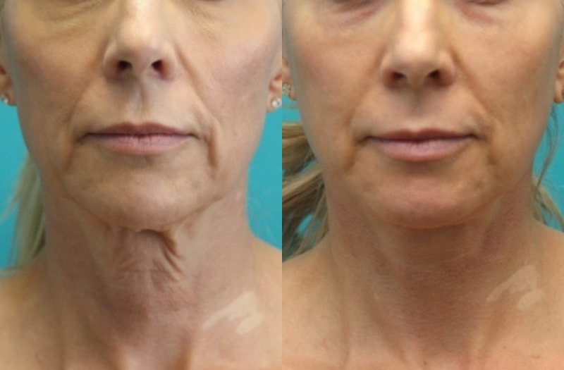 A result from Modern Surgical Arts of Denver