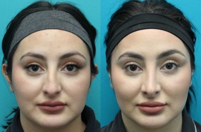 A result from Modern Surgical Arts of Denver
