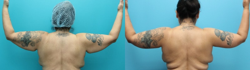 A result from Modern Surgical Arts of Denver