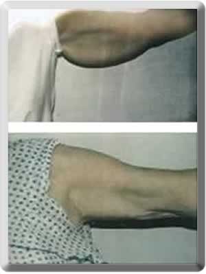 A result from Peter J. Simon, MD