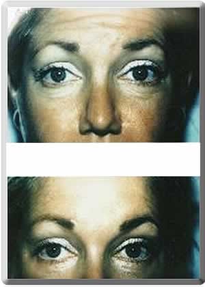 A result from Peter J. Simon, MD