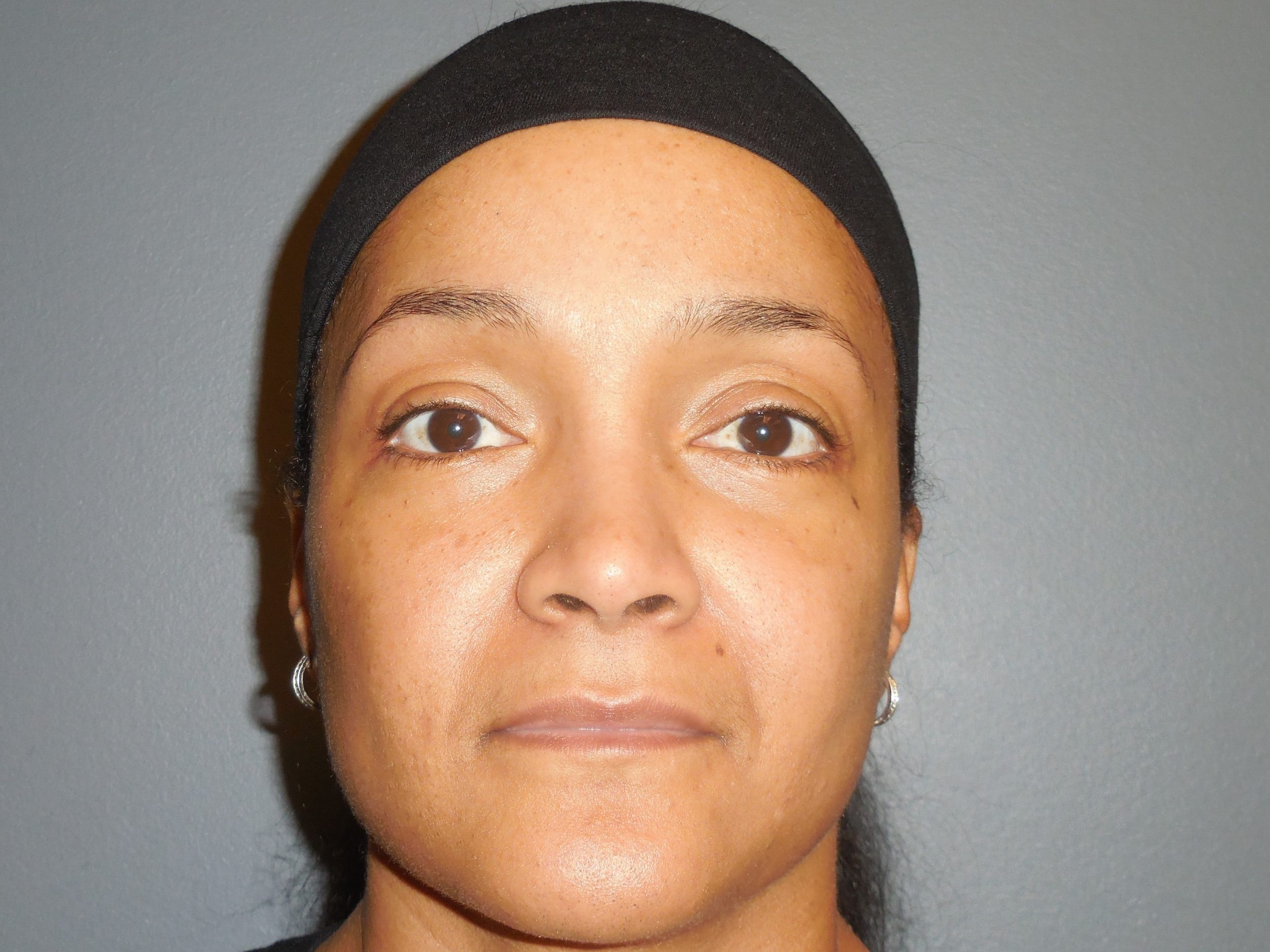 A result from Aesthetic Plastic Surgery & Laser Center, Michelle Hardaway M.D.