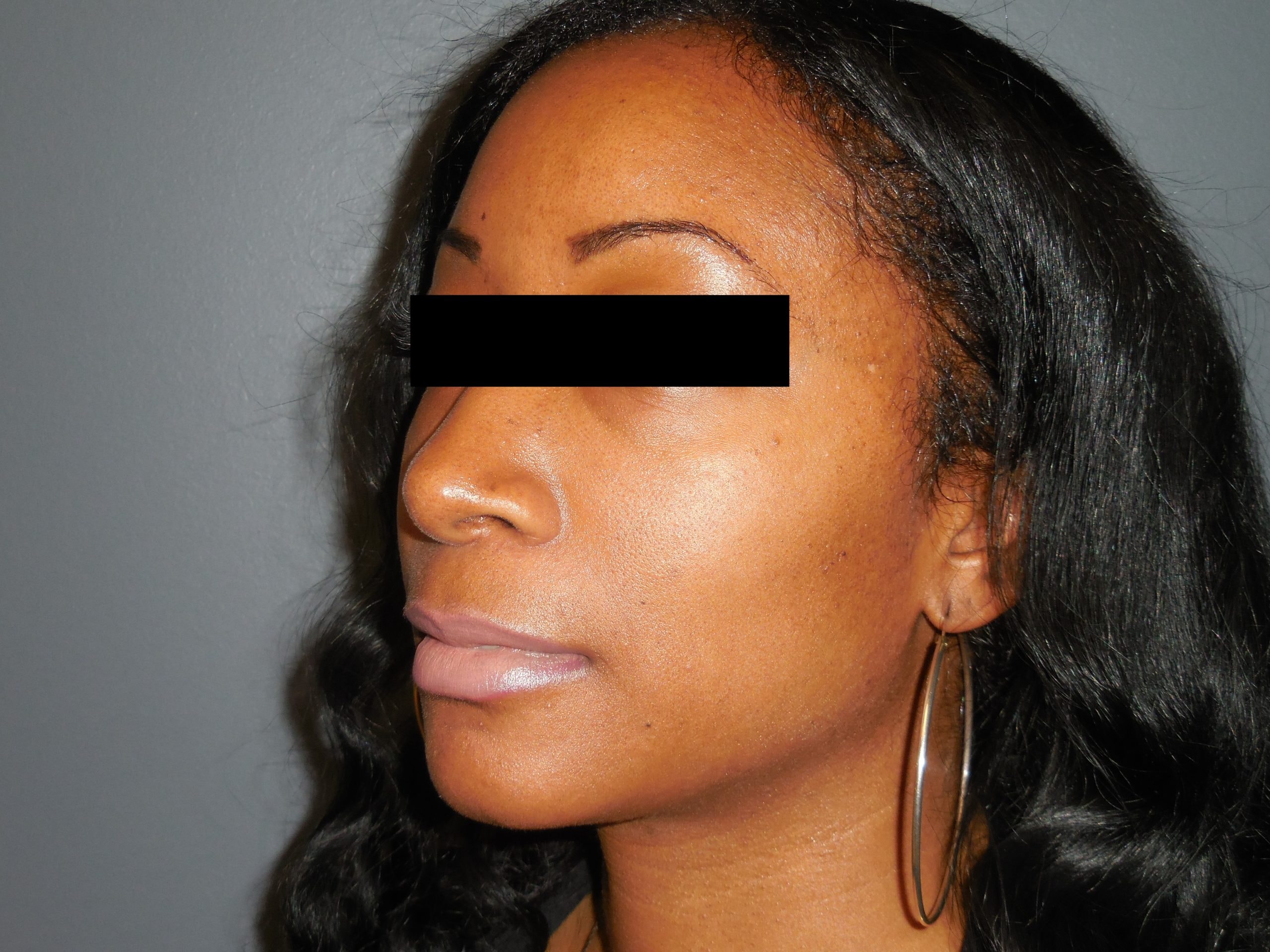 A result from Aesthetic Plastic Surgery & Laser Center, Michelle Hardaway M.D.