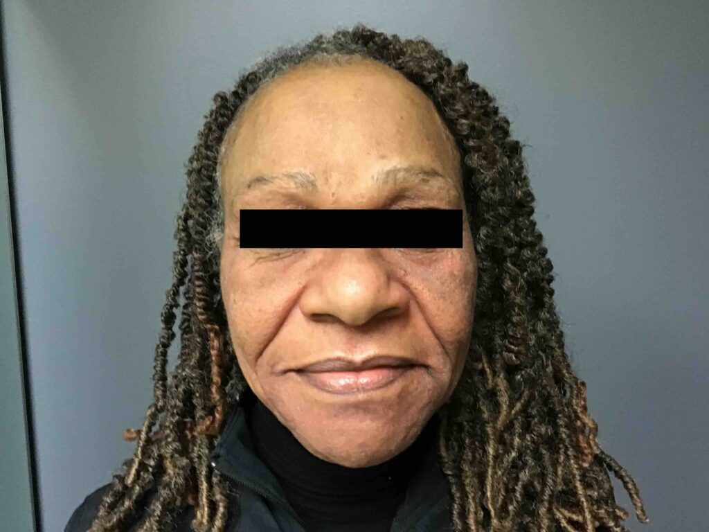 A result from Aesthetic Plastic Surgery & Laser Center, Michelle Hardaway M.D.