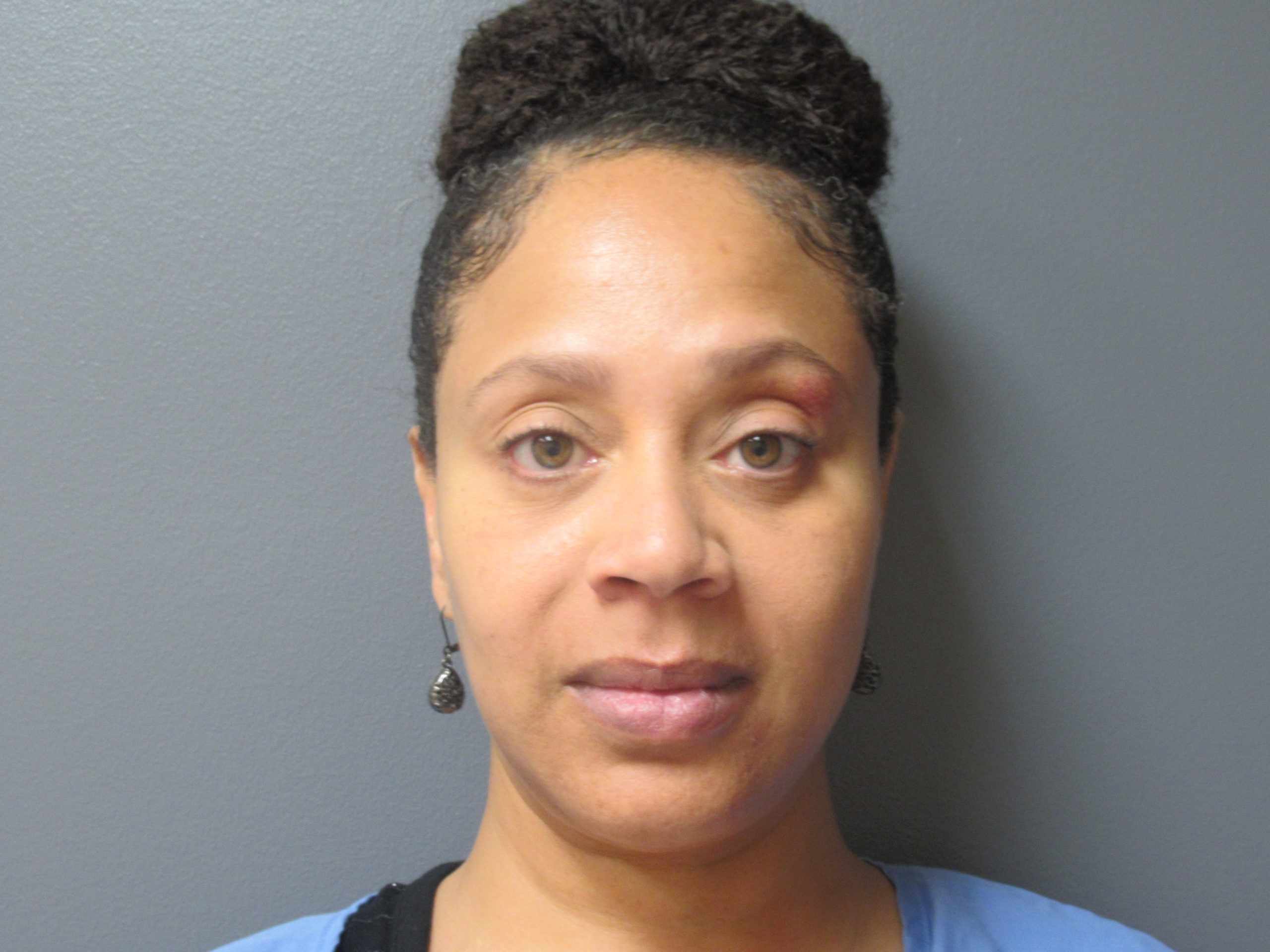 A result from Aesthetic Plastic Surgery & Laser Center, Michelle Hardaway M.D.