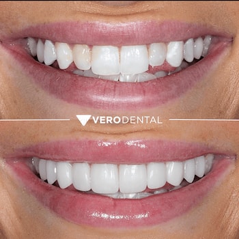 A result from Vero Dental