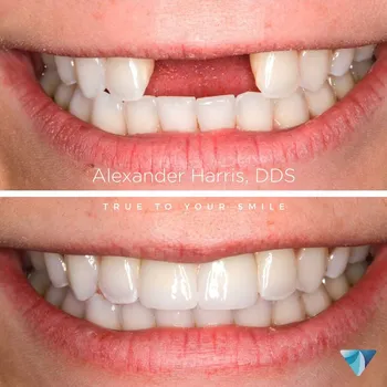 Dental Implants result at Vero Dental