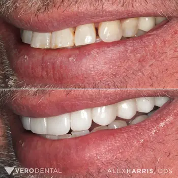 Dental Crowns result at Vero Dental