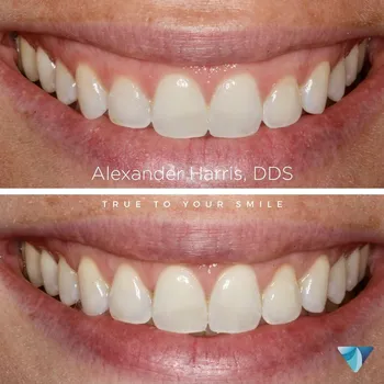 Gum Reshaping result at Vero Dental