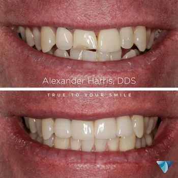 Dental Crowns result at Vero Dental