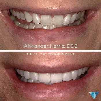 Dental Crowns result at Vero Dental
