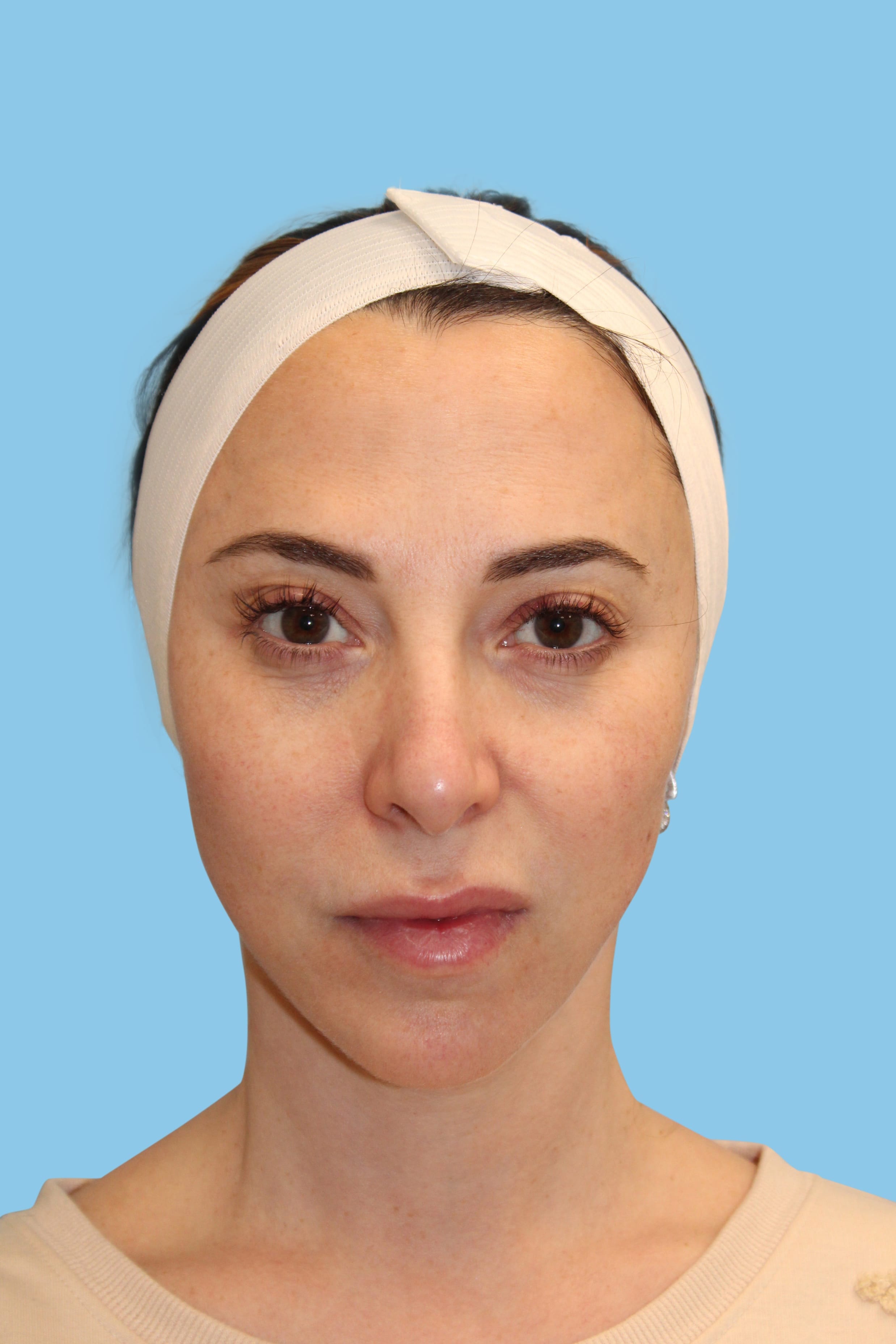 A result from Warner Aesthetic & Reconstructive Institute