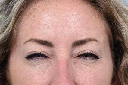A result from La Jolla Facial Plastic Surgery: Victor Chung, MD