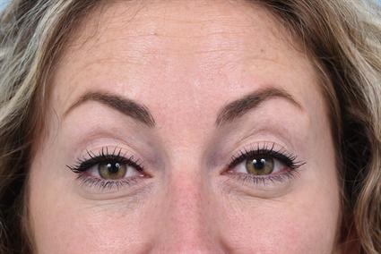 A result from La Jolla Facial Plastic Surgery: Victor Chung, MD
