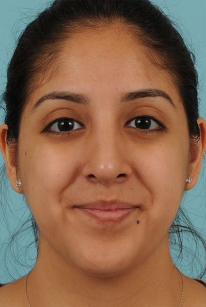 A result from La Jolla Facial Plastic Surgery: Victor Chung, MD