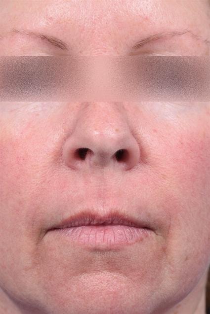 A result from La Jolla Facial Plastic Surgery: Victor Chung, MD