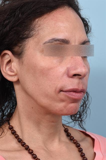 A result from La Jolla Facial Plastic Surgery: Victor Chung, MD