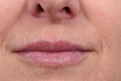 A result from La Jolla Facial Plastic Surgery: Victor Chung, MD