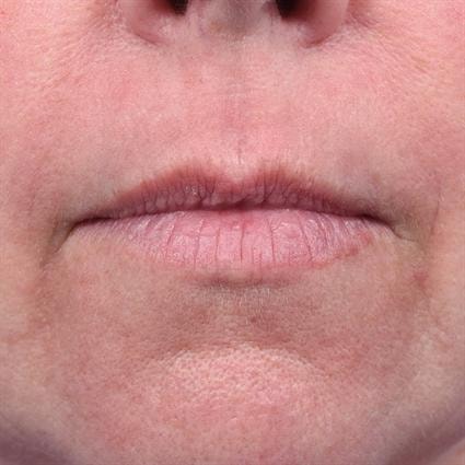 A result from La Jolla Facial Plastic Surgery: Victor Chung, MD