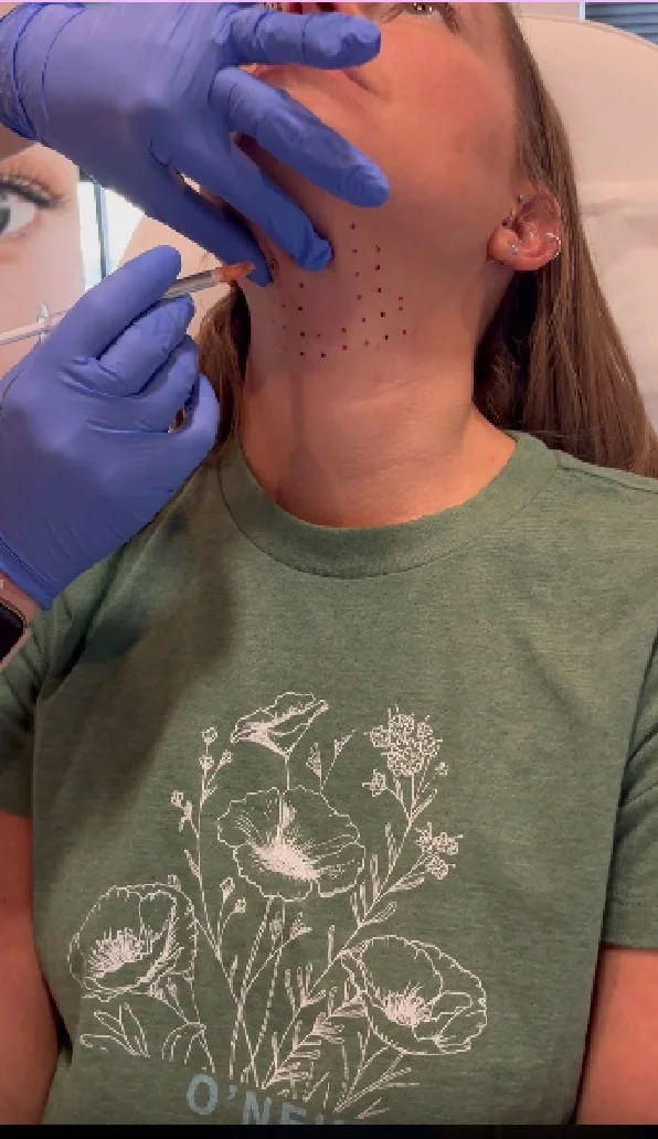 Femme Moderne Center for Aesthetics cheek filler result — Draper, UT