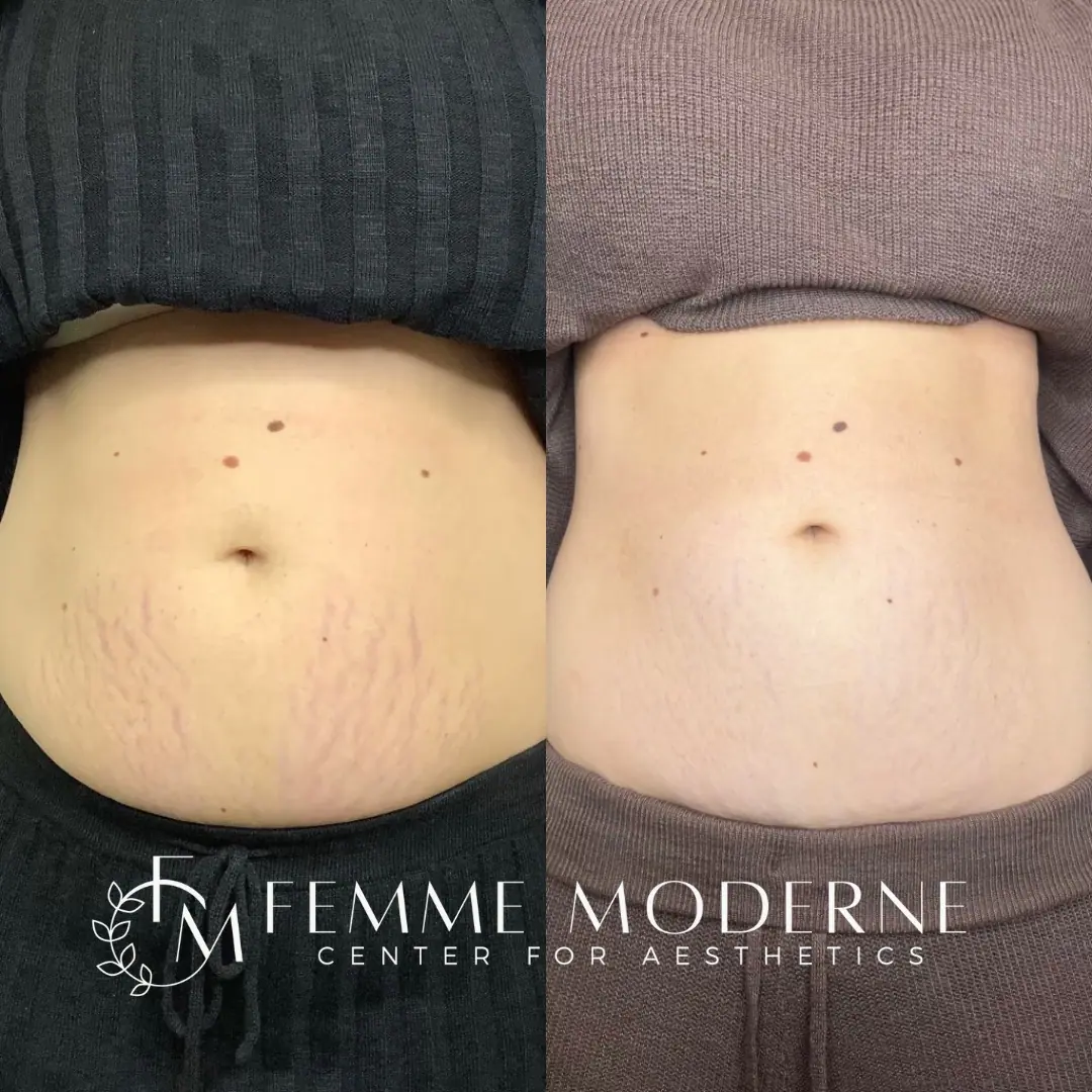Femme Moderne Center for Aesthetics laser treatment result — Draper, UT