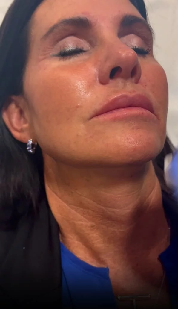Cheek Filler result at Femme Moderne Center for Aesthetics