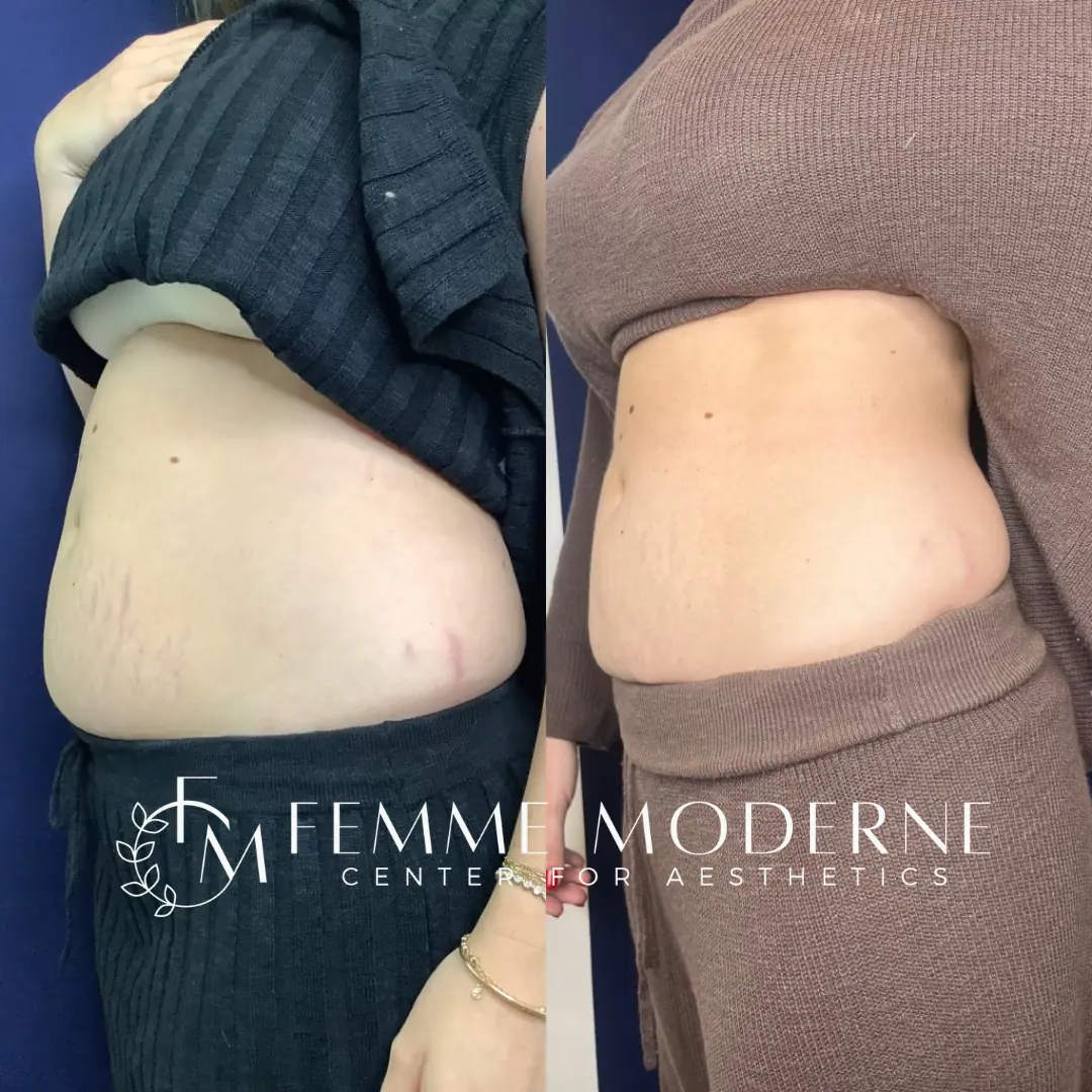 Femme Moderne Center for Aesthetics laser treatment result — Draper, UT