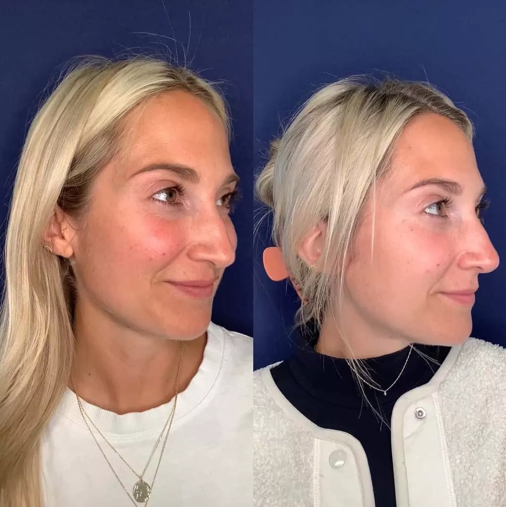 Femme Moderne Center for Aesthetics result — Draper, UT