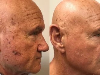 Laser Treatment result at Femme Moderne Center for Aesthetics