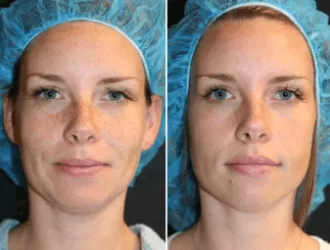 Laser Treatment before photo