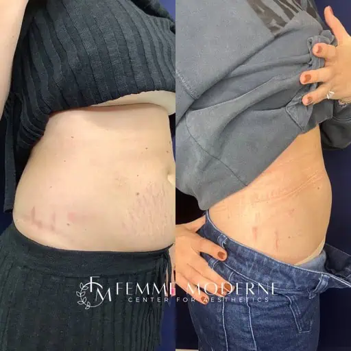 Laser Treatment result at Femme Moderne Center for Aesthetics
