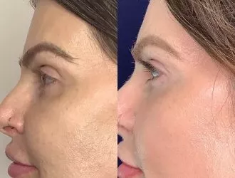 Femme Moderne Center for Aesthetics laser treatment after — Draper, UT