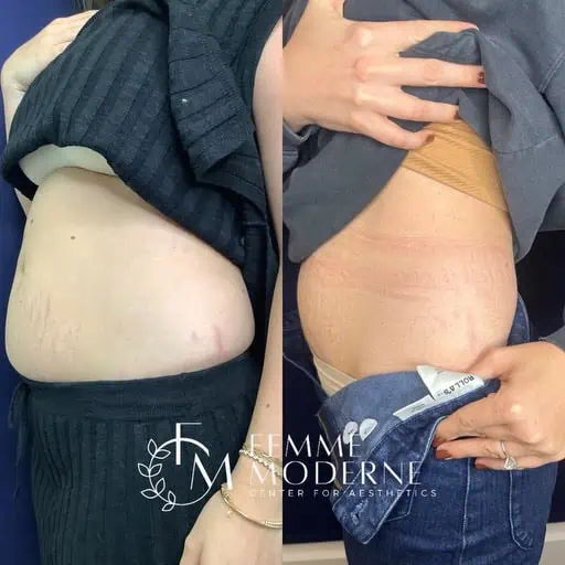 Laser Treatment result at Femme Moderne Center for Aesthetics