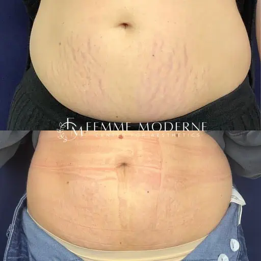 Femme Moderne Center for Aesthetics laser treatment result — Draper, UT